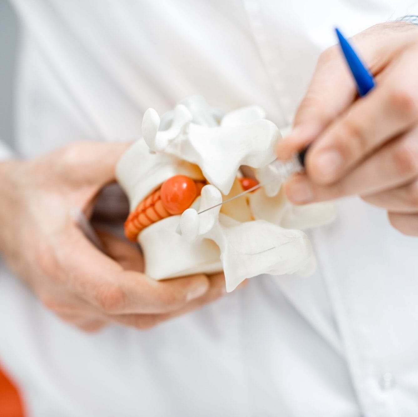 Anatomical model of vertebras with intervertebral hernia