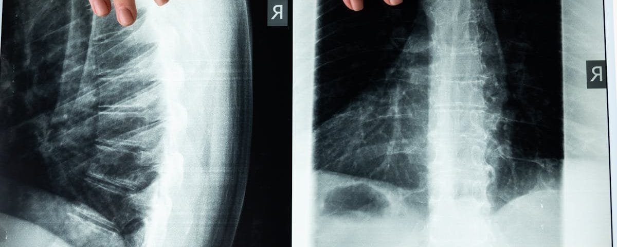 découvrez les bienfaits de la décompression spinale, une technique innovante pour soulager les douleurs dorsales et améliorer la santé de votre colonne vertébrale. apprenez comment cette approche non invasive peut vous aider à retrouver un meilleur bien-être et à reprendre vos activités quotidiennes sans douleur.