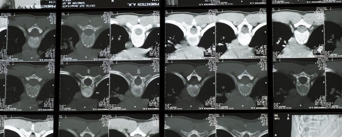 découvrez les bienfaits de la décompression spinale : une thérapie douce et efficace pour soulager les douleurs dorsales, améliorer la posture et favoriser la santé de la colonne vertébrale.