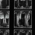 découvrez les causes, symptômes et traitements de la sciatique, une douleur courante qui affecte le nerf sciatique. apprenez comment soulager votre inconfort et améliorer votre qualité de vie grâce à des conseils d'experts.