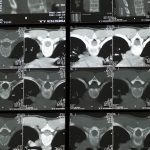 découvrez les bienfaits de la décompression spinale, une thérapie innovante qui soulage les douleurs lombaires et cervicales. améliorez votre mobilité et retrouvez votre qualité de vie grâce à des techniques adaptées et des conseils d'experts en santé.