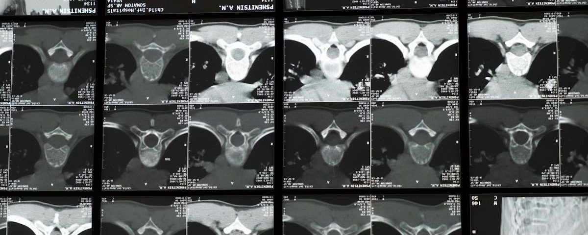 découvrez les bienfaits de la décompression spinale, une méthode thérapeutique innovante visant à soulager les douleurs dorsales et à favoriser la santé de la colonne vertébrale. améliorez votre qualité de vie grâce à des traitements adaptés qui ciblent les causes profondes de vos maux de dos.
