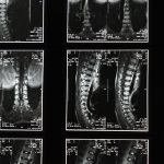découvrez les causes, symptômes et traitements de la sciatique. informez-vous sur les solutions pour soulager la douleur et améliorer votre qualité de vie. retrouvez des conseils pratiques et des recommandations pour mieux comprendre cette condition affectant le nerf sciatique.