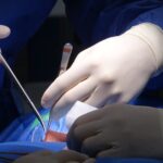 découvrez tout sur la sténose foraminale, une affection qui peut provoquer des douleurs et des engourdissements en raison de la compression des nerfs. apprenez à identifier les symptômes, les causes et les options de traitement pour améliorer votre qualité de vie.