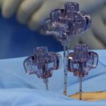 découvrez tout ce que vous devez savoir sur la sténose foraminale : causes, symptômes, diagnostics et options de traitement. apprenez comment cette condition peut affecter votre santé et les meilleures pratiques pour soulager la douleur et améliorer votre qualité de vie.