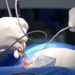 la sténose foraminale est un rétrécissement des trous par lesquels les nerfs sortent de la colonne vertébrale, provoquant douleurs et engourdissements. découvrez les causes, symptômes et options de traitement de cette condition médicale.