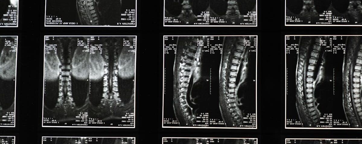 découvrez les bienfaits de la décompression spinal, une technique innovante pour soulager les douleurs et améliorer la mobilité de votre colonne vertébrale. profitez d'une approche non chirurgicale pour retrouver bien-être et qualité de vie.