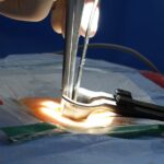 découvrez tout ce que vous devez savoir sur la sténose spinale, y compris ses symptômes, causes, diagnostics et options de traitement. informez-vous sur les méthodes pour soulager la douleur et améliorer votre qualité de vie.