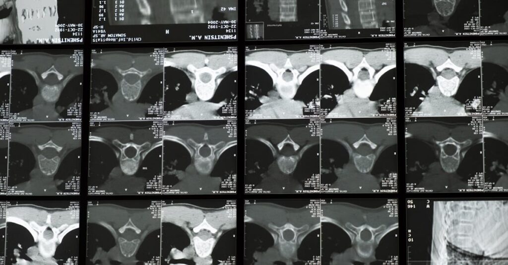 découvrez la décompression spinale, une technique innovante pour soulager les douleurs dorsales et améliorer la santé de votre colonne vertébrale. informez-vous sur ses bienfaits, son fonctionnement et ses indications.