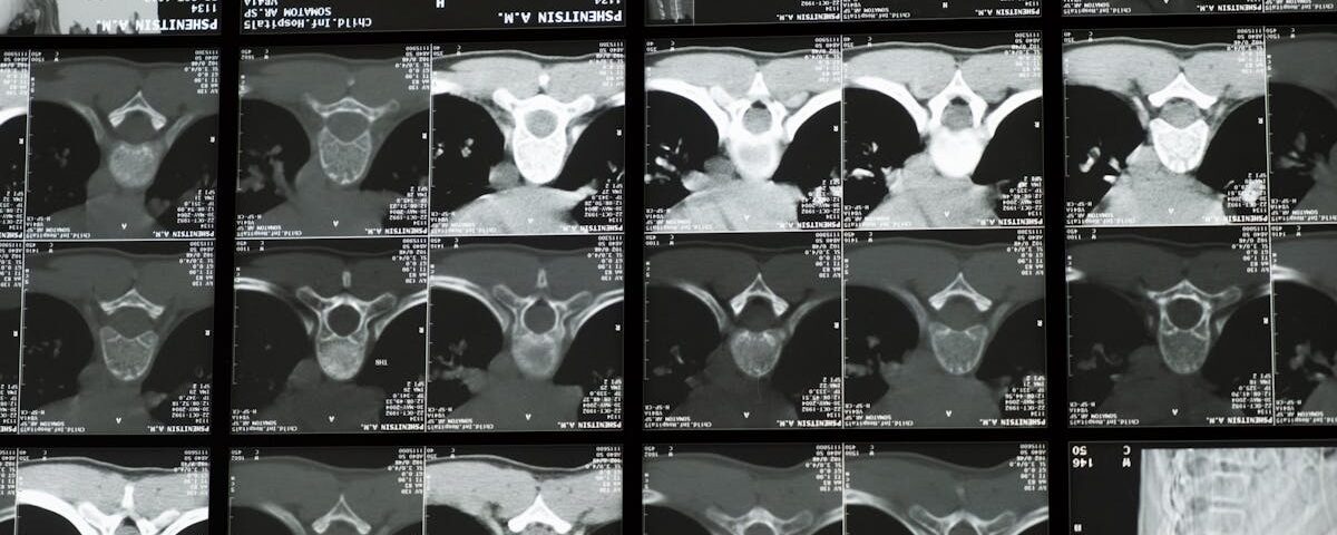 découvrez la décompression spinale, une technique innovante pour soulager les douleurs dorsales et améliorer la santé de votre colonne vertébrale. informez-vous sur ses bienfaits, son fonctionnement et ses indications.