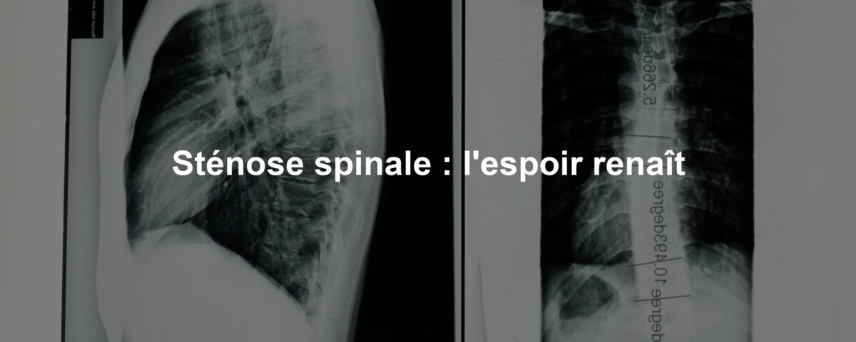 Sténose spinale : l'espoir renaît