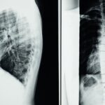 découvrez les symptômes, causes et traitements de l'arthrose lombaire avec sténose, une affection qui provoque des douleurs au bas du dos et des difficultés de mobilité.