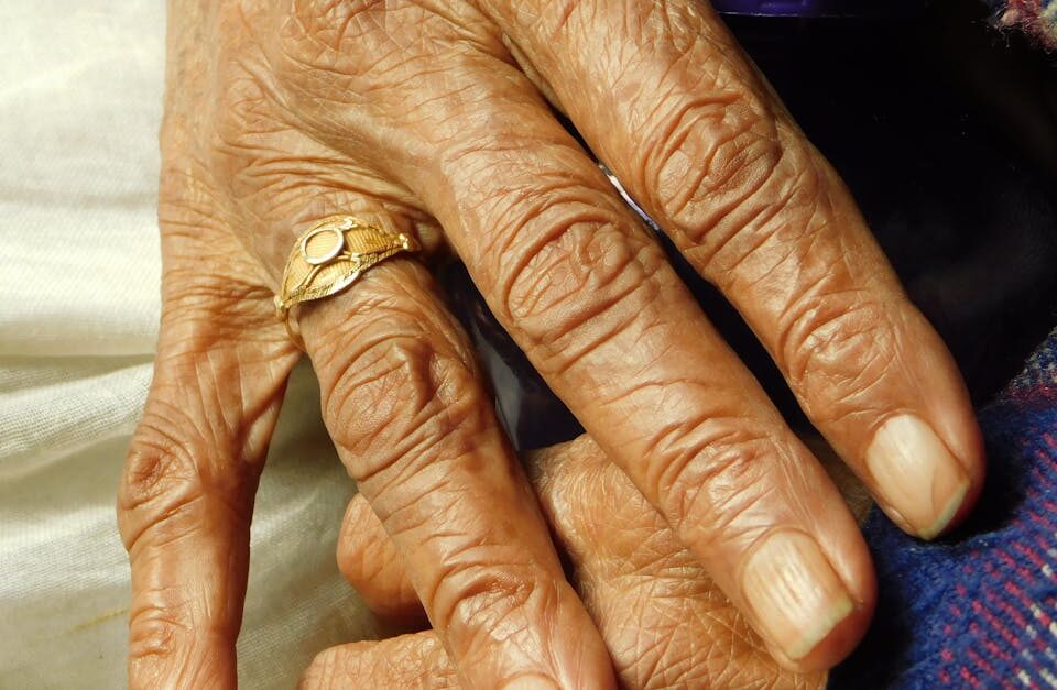 découvrez tout sur l'arthrite : symptômes, causes et traitements pour mieux gérer cette maladie inflammatoire des articulations.