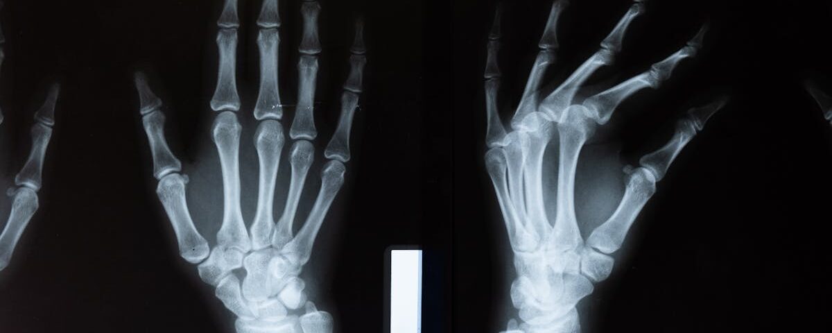 découvrez tout sur l'arthrose, ses causes, symptômes et traitements pour mieux gérer cette maladie articulaire chronique.