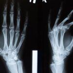 découvrez tout sur l'arthrose, ses causes, symptômes et traitements pour mieux gérer cette maladie articulaire chronique.