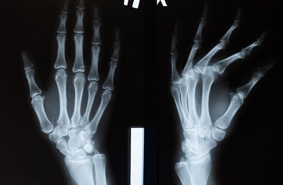 découvrez tout sur l'arthrose, ses causes, symptômes et traitements pour mieux gérer cette maladie articulaire chronique.