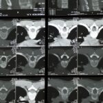 la décompression neurovertébrale est une technique douce et non invasive visant à soulager la pression sur les nerfs rachidiens, réduisant ainsi douleurs et améliorant la mobilité.