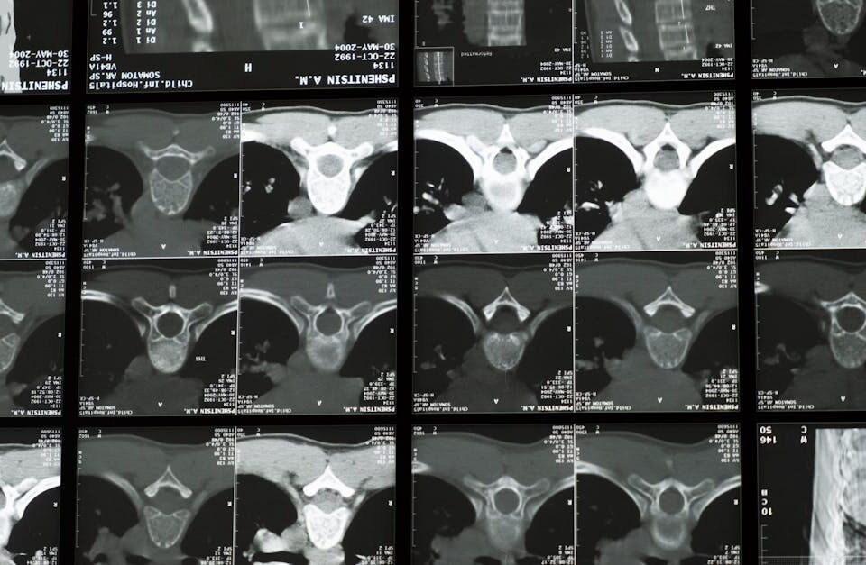 la décompression neurovertébrale est une technique douce et non invasive visant à soulager la pression sur les nerfs rachidiens, réduisant ainsi douleurs et améliorant la mobilité.