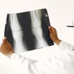 évaluation initiale de l'arthrose : guide complet pour diagnostiquer et comprendre les premiers signes de l'arthrose afin d'adapter un traitement efficace.