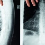 découvrez les options de traitement efficaces pour l'arthrose lombaire afin de soulager la douleur et améliorer la mobilité.