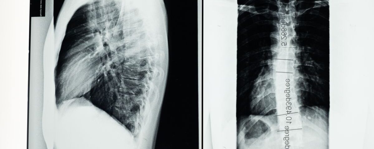 découvrez les causes, symptômes et traitements de l'arthrose cervicale, une maladie qui affecte les articulations du cou et peut provoquer douleurs et raideurs.