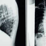 découvrez les causes, symptômes et traitements de l'arthrose cervicale, une maladie qui affecte les articulations du cou et peut provoquer douleurs et raideurs.