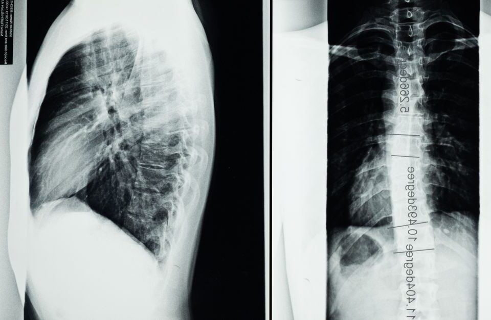 découvrez les causes, symptômes et traitements de l'arthrose cervicale, une maladie qui affecte les articulations du cou et peut provoquer douleurs et raideurs.