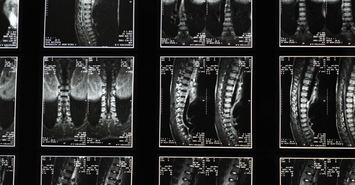 découvrez la décompression spinale, une technique efficace pour soulager la douleur dorsale en réduisant la pression sur la colonne vertébrale.