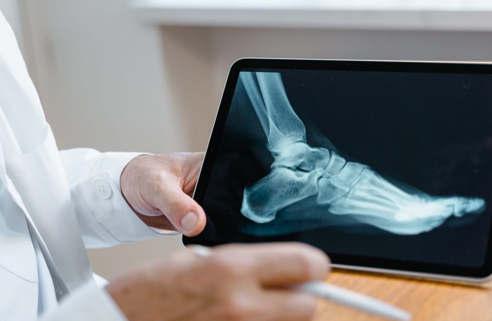 découvrez tout sur l'arthrose : symptômes, causes, traitements et conseils pour mieux gérer cette maladie articulaire chronique.