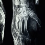 découvrez la décompression dans le traitement de l'arthrose : méthodes, bénéfices et conseils pour soulager les douleurs articulaires et améliorer la mobilité.