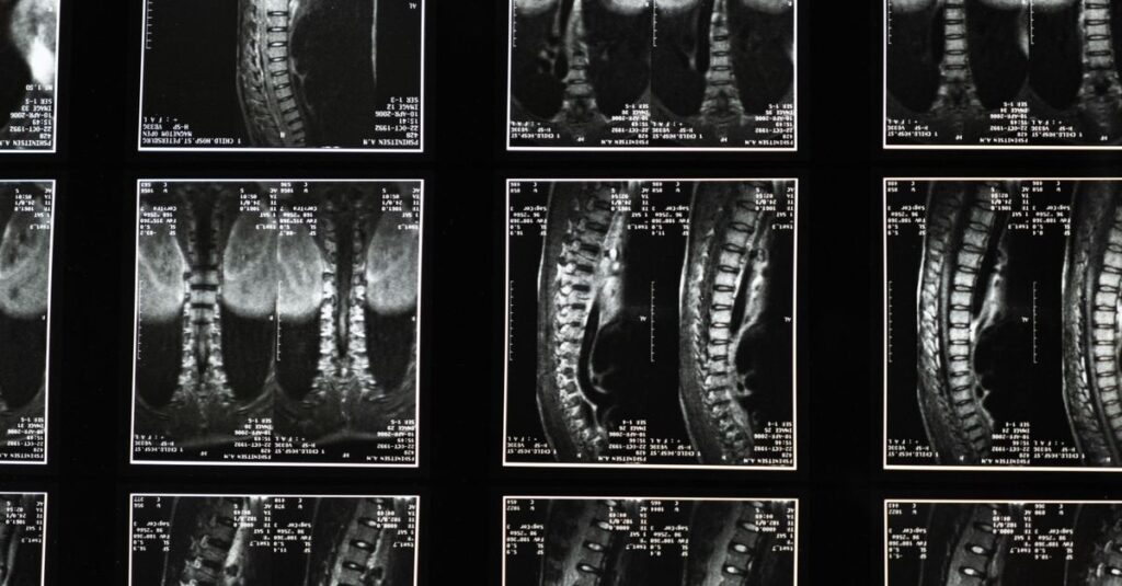 découvrez la décompression neurovertébrale, une technique thérapeutique innovante visant à soulager les douleurs dorsales et cervicales en réduisant la pression sur les nerfs spinaux.