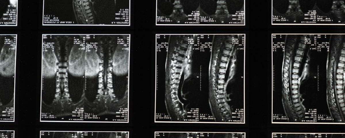 découvrez la décompression neurovertébrale, une technique thérapeutique innovante visant à soulager les douleurs dorsales et cervicales en réduisant la pression sur les nerfs spinaux.