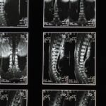 découvrez la décompression neurovertébrale, une technique thérapeutique innovante visant à soulager les douleurs dorsales et cervicales en réduisant la pression sur les nerfs spinaux.