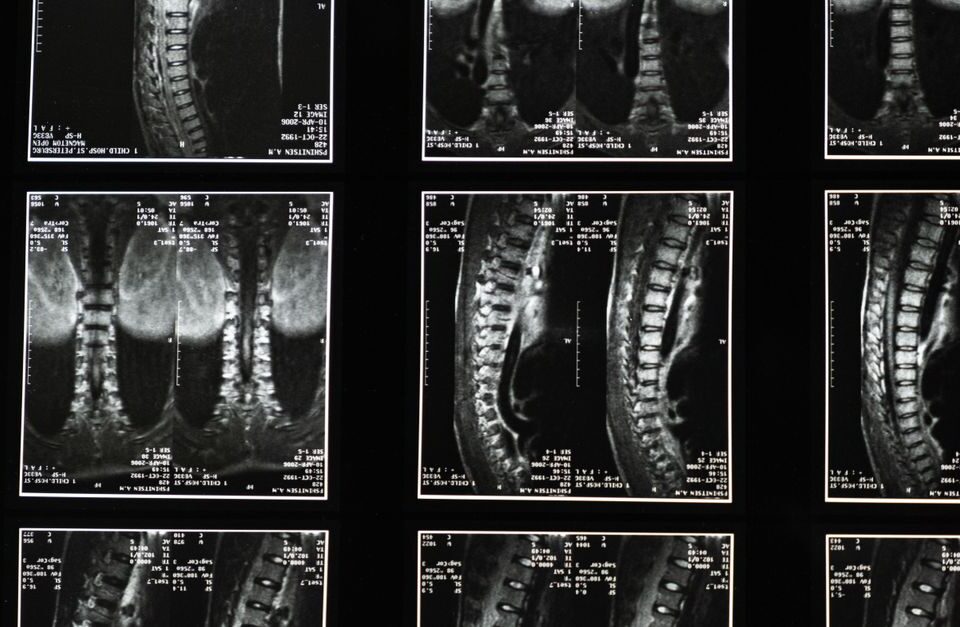 découvrez la décompression neurovertébrale, une technique thérapeutique innovante visant à soulager les douleurs dorsales et cervicales en réduisant la pression sur les nerfs spinaux.